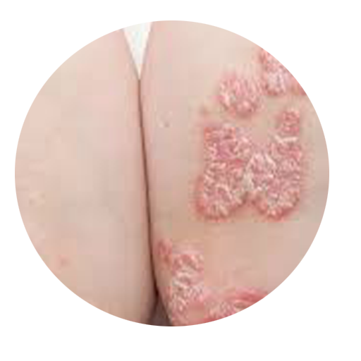 psoriasis treatment