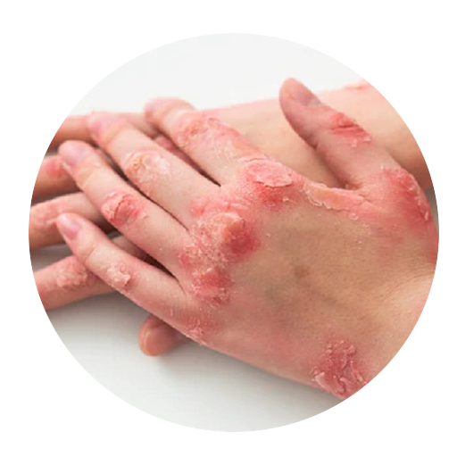 psoriasis treatment